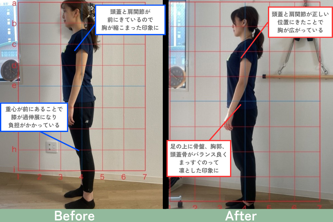 長年悩んでいた姿勢の悪さがたった5ヶ月で改善されました！【20代 